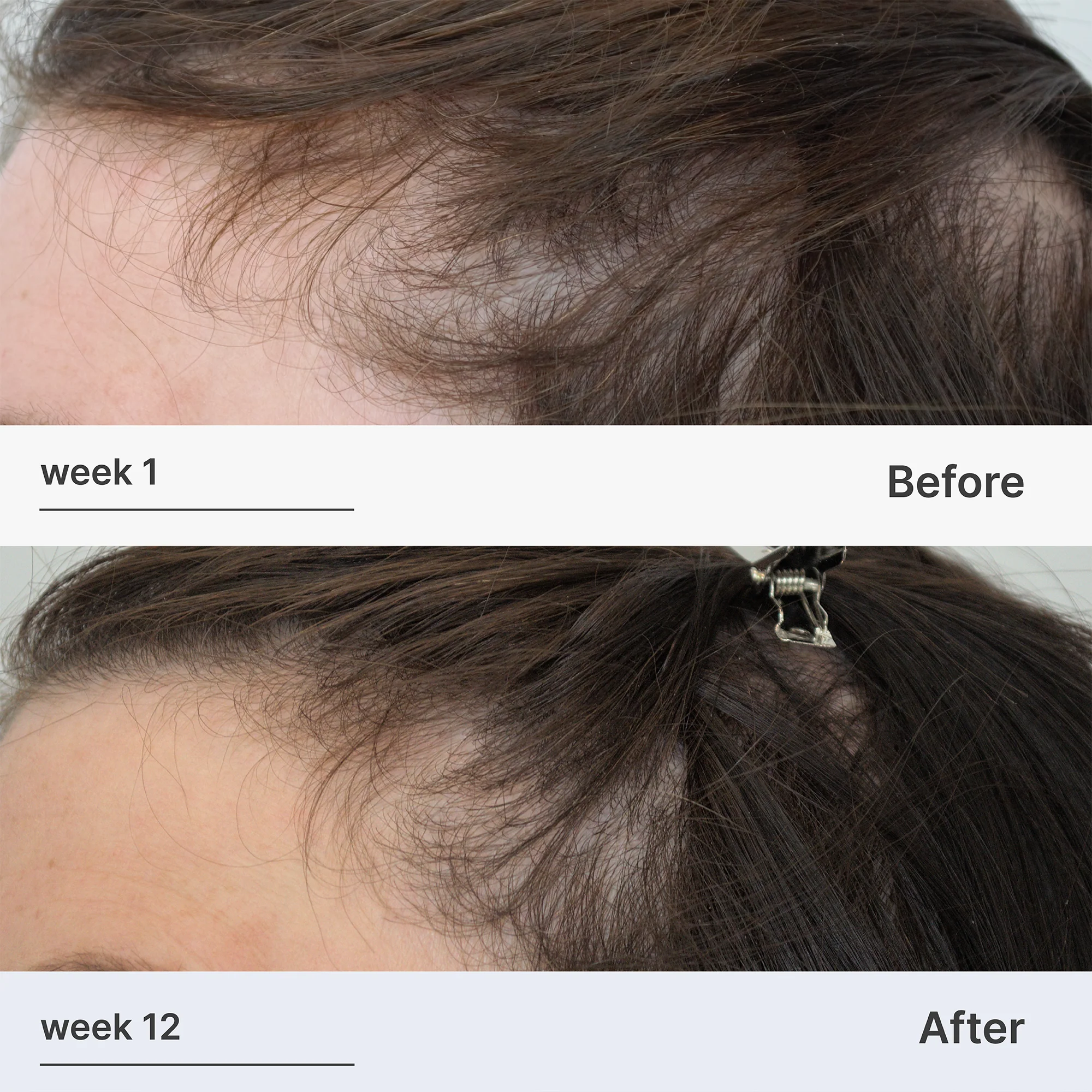 Superpower™ Thickening Hairpatches