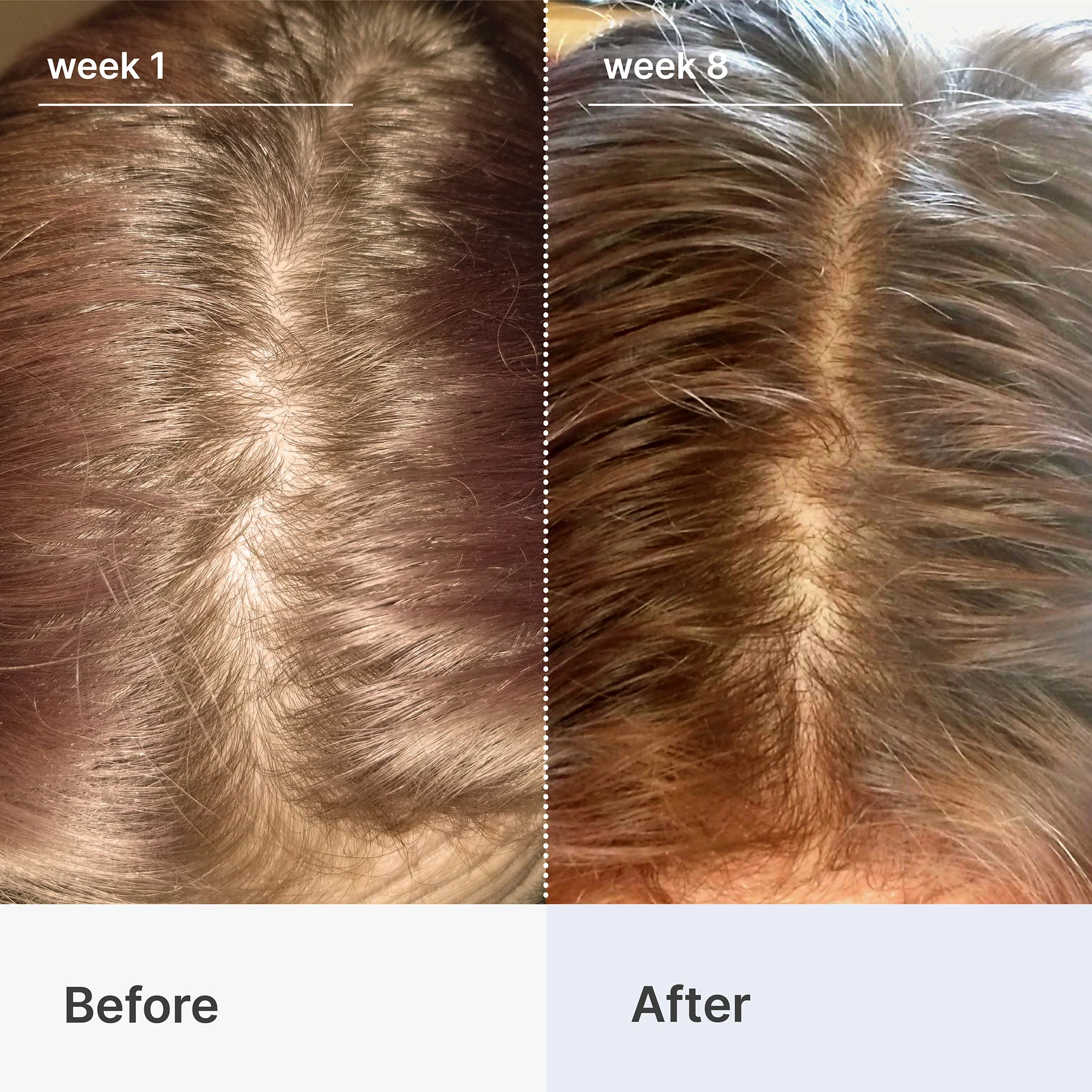 Hair Loss Starter Bundle